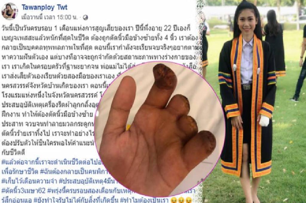 สาวปี4ฝันสลายฝึกงานเสีย4นิ้ว เป็น'คนพิการ'ตลอดชีวิต